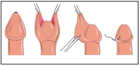 male circumcision procedure
