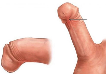 penile frenulectomy toronto